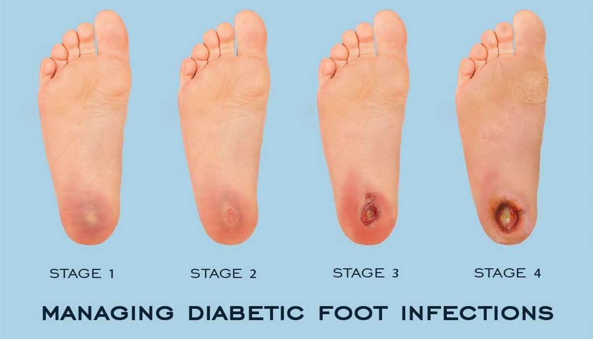 Foot Ulcer Stages Pictures 1 Symptoms And Pictures 1088