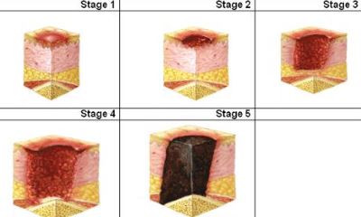 Foot ulcer stages pictures