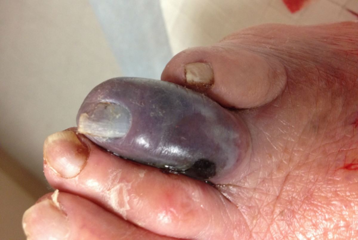 Gangrene toe pictures