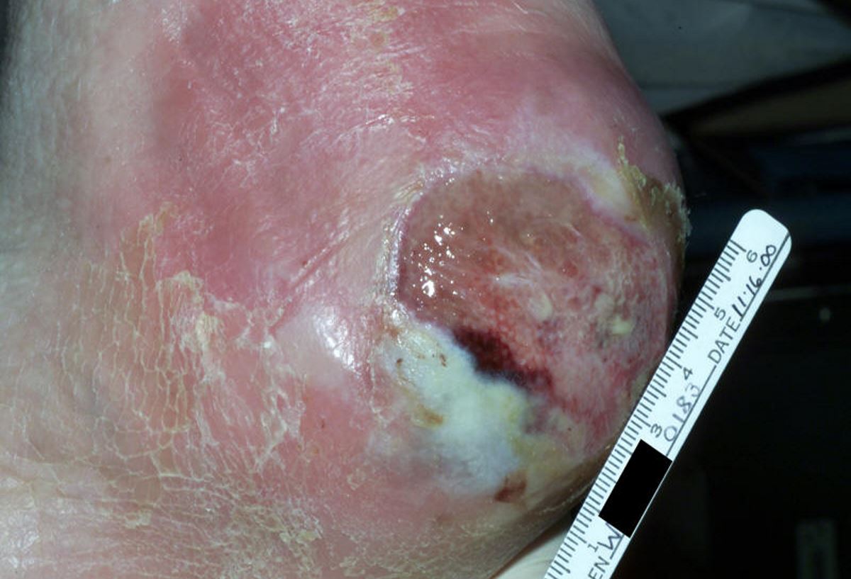 Heel ulcer pictures