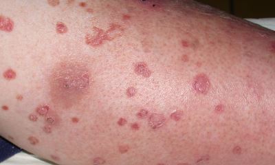 Pictures of diabetic sores