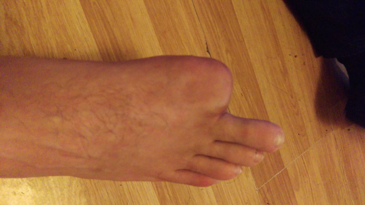 Toe amputation pictures