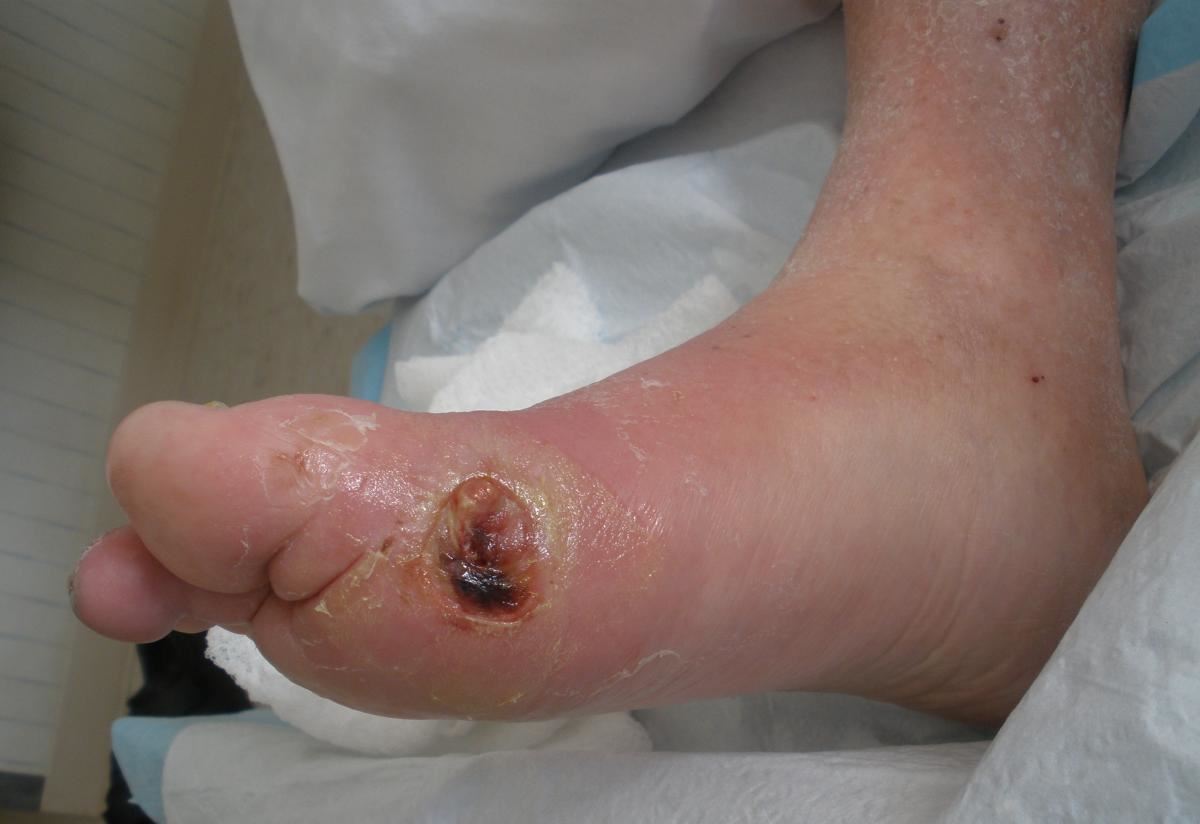 What does a foot ulcer look like