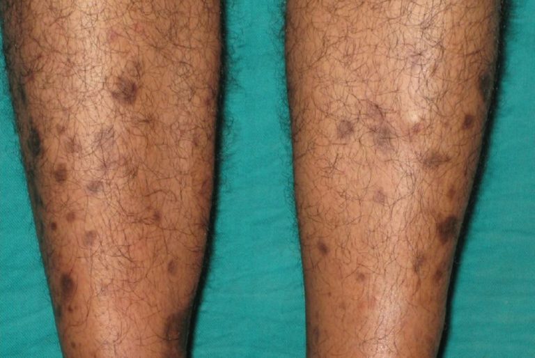 What does diabetic skin look like | Symptoms and pictures