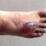 Blisters on feet pictures