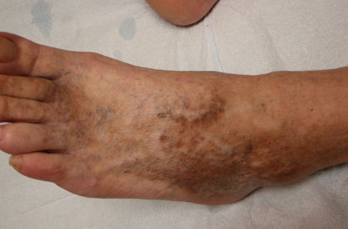 Brown spots on top of feet pictures