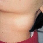 Cervical osteochondrosis photos