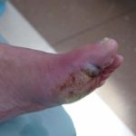 Diabetes feet symptoms pictures
