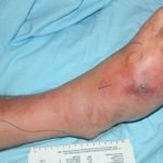 Diabetic feet photos