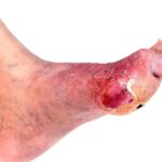 Diabetic feet pictures 1