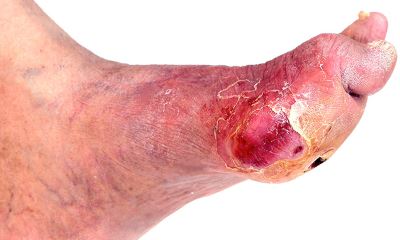 Diabetic feet pictures