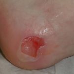 Diabetic foot blisters pictures
