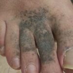 Diabetic foot discoloration pictures