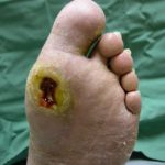 Diabetic foot infection pictures