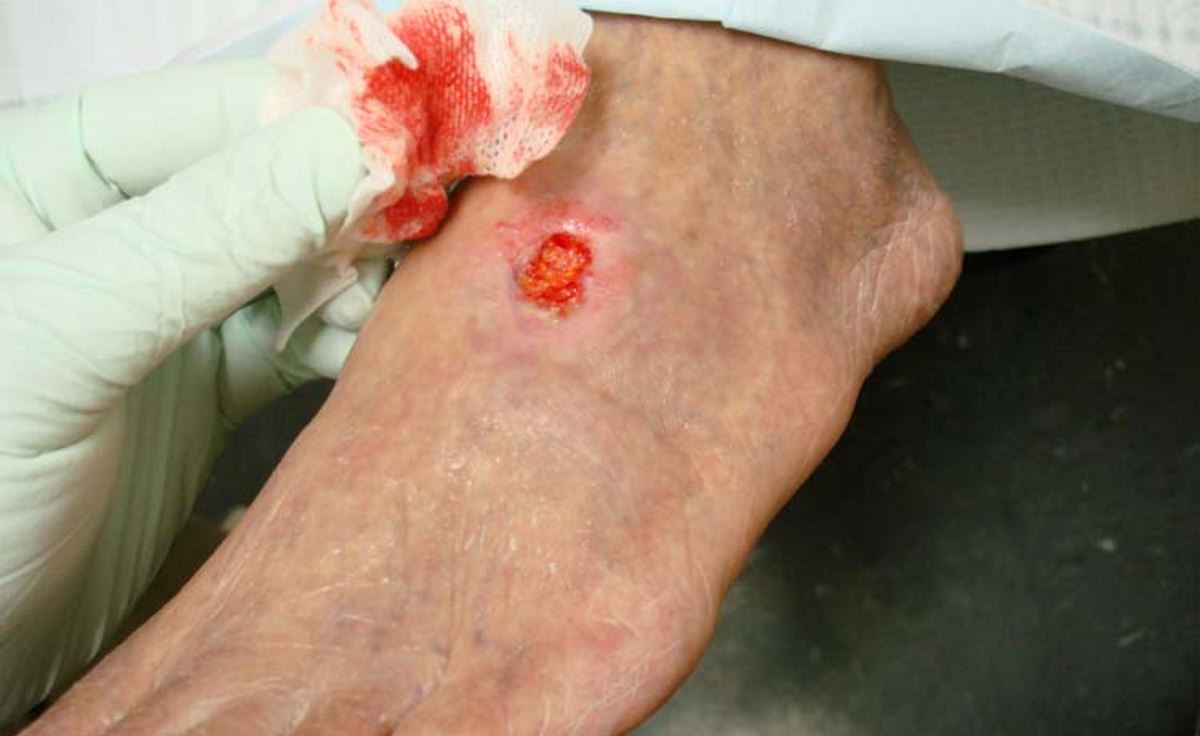 Diabetic ulcers on feet pictures