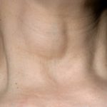 Edema of neck pictures
