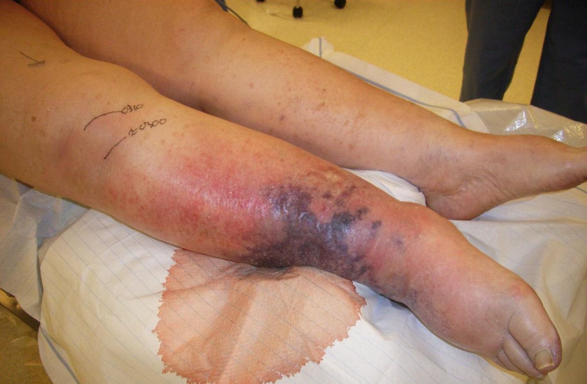 Gangrene pictures leg