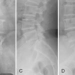 Lumbar osteochondrosis pictures
