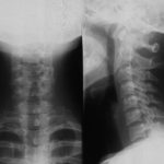 Osteochondrosis of cervical segment pictures