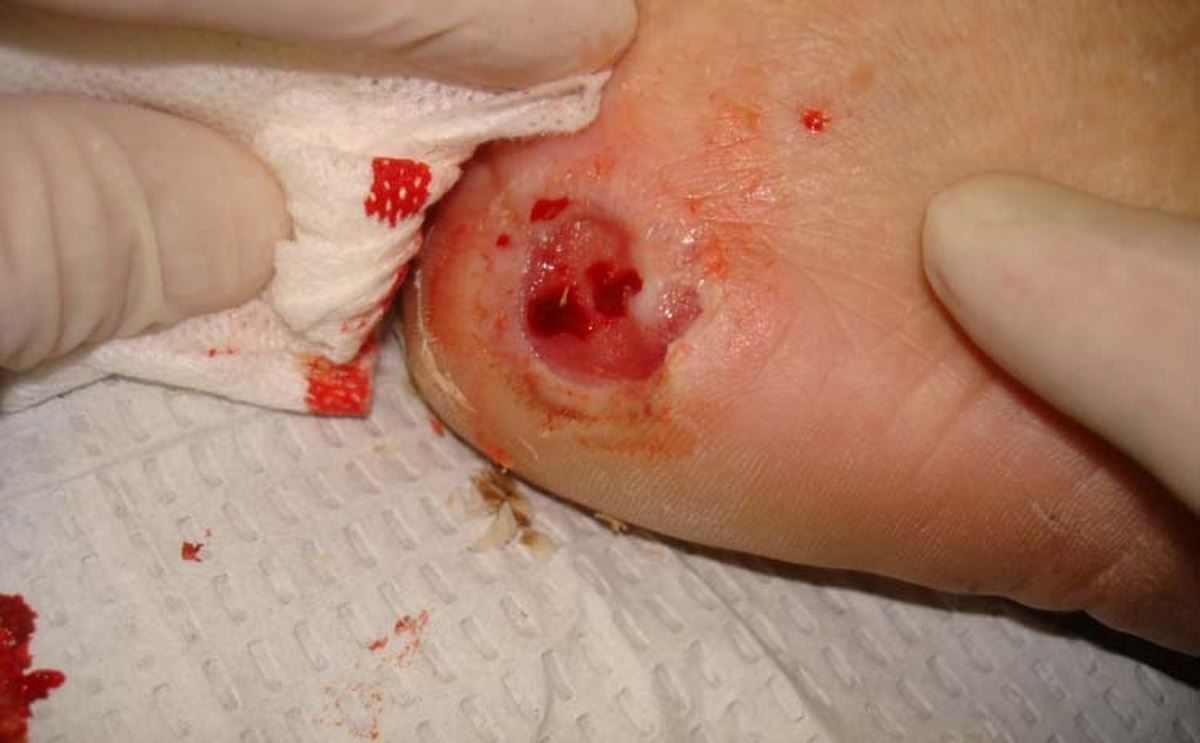 Pressure sores on feet pictures