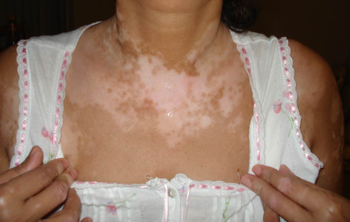 Symptoms of vitiligo photos