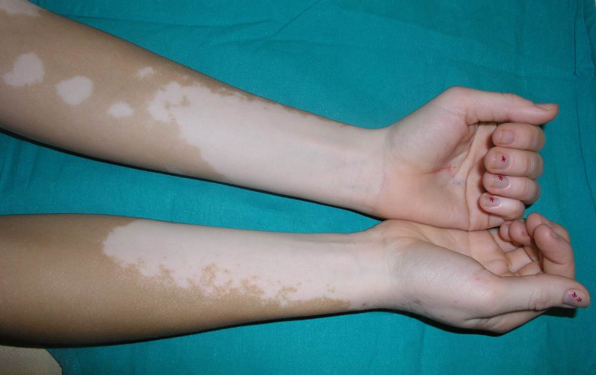 The skin disease vitiligo pictures