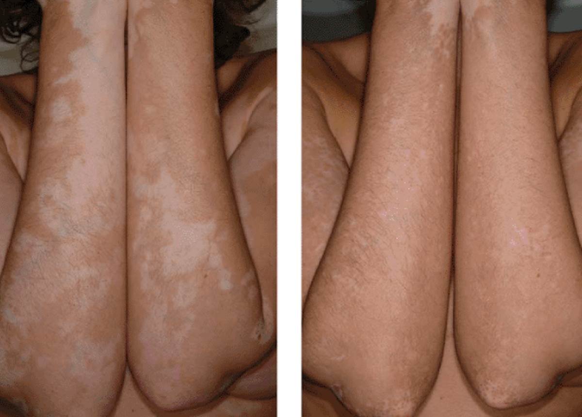 Treatment for vitiligo pictures before and after