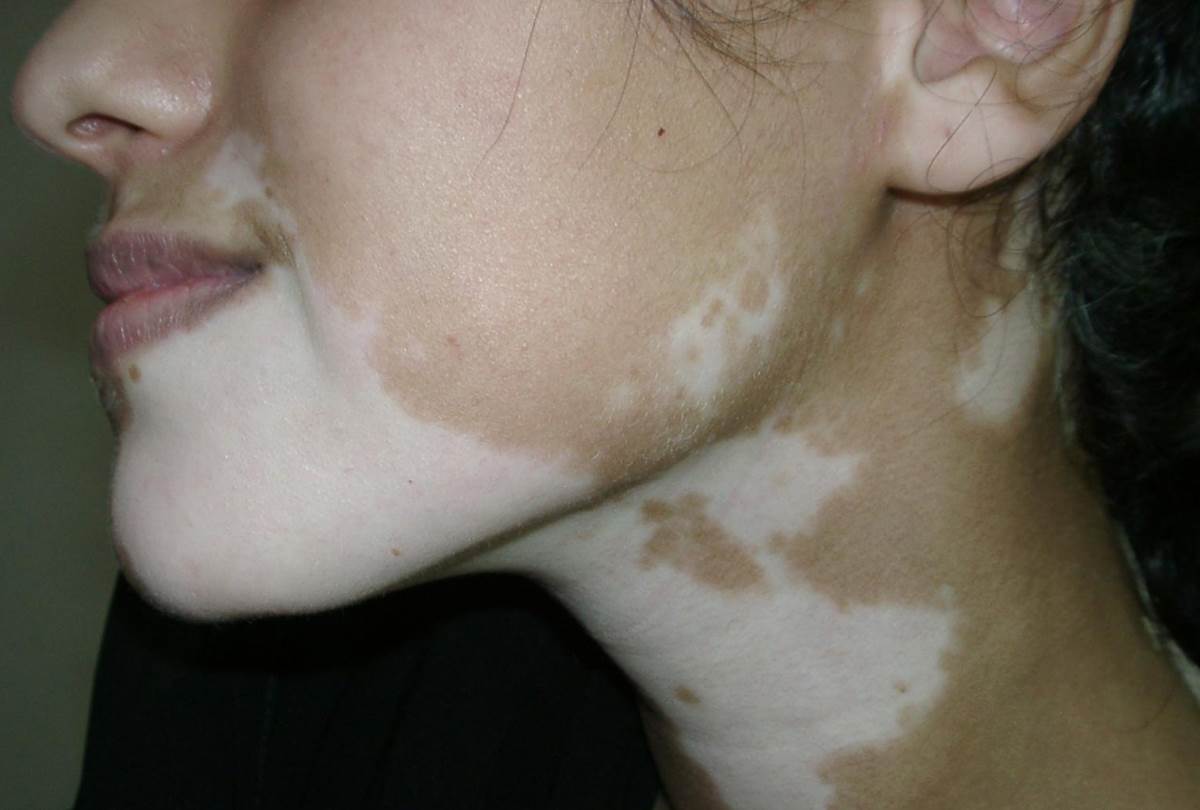 Vitiligo disease pictures