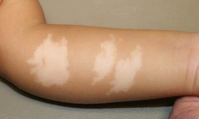 Early stage vitiligo  pictures vitiligo  treatment  pictures 