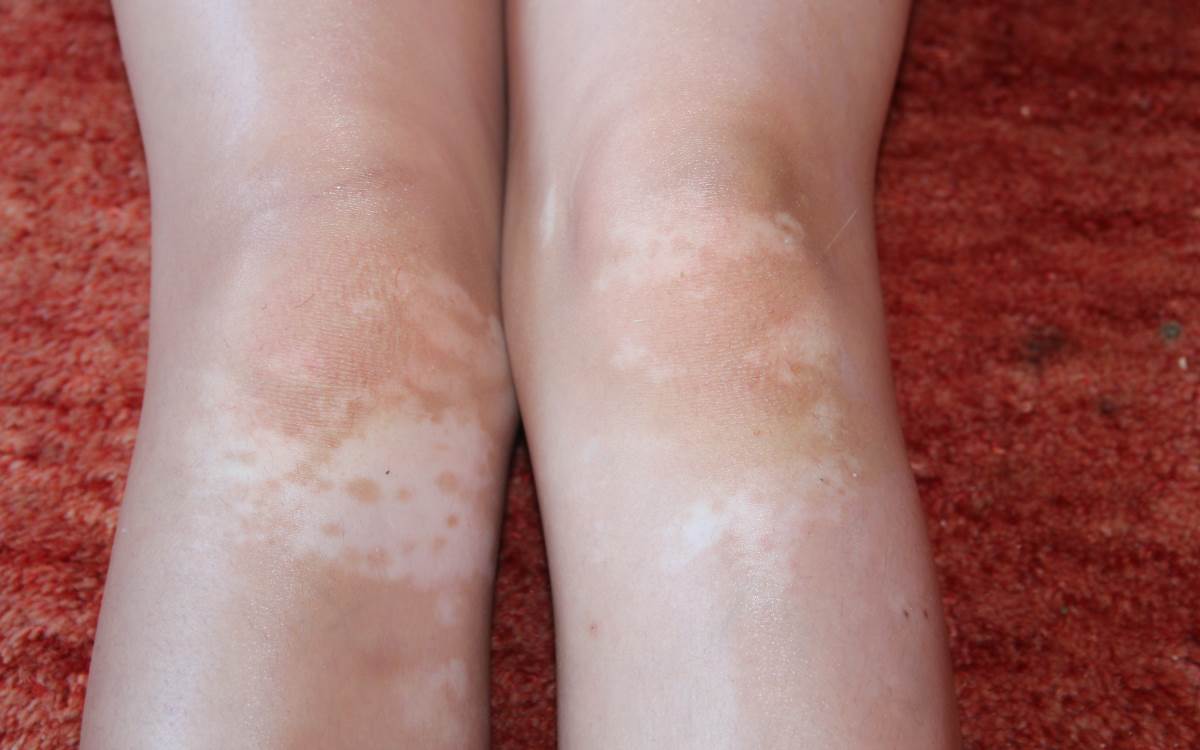 Vitiligo in legs pictures