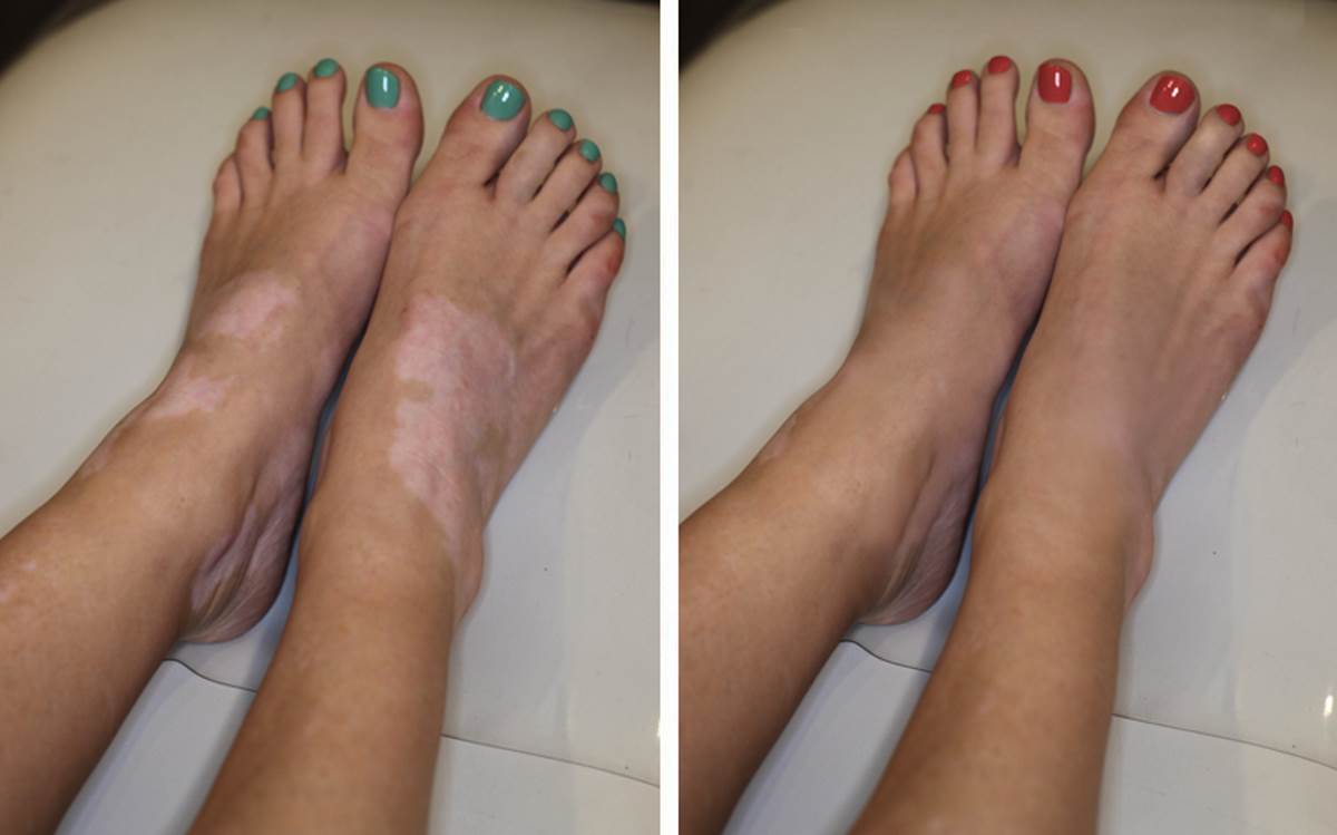 Vitiligo Treatment Pictures Before And After Symptoms And Pictures