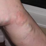 DVT blood clot symptoms pictures