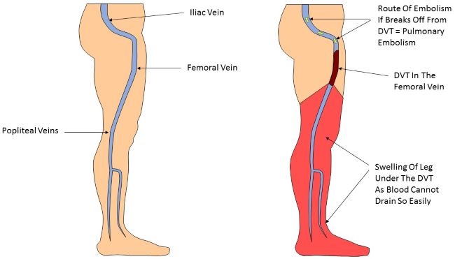 Deep vein thrombosis pictures 1