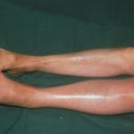 Deep vein thrombosis pictures 2