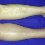 Deep vein thrombosis symptoms leg pictures