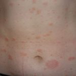 Early symptoms of psoriasis pictures