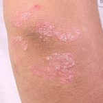First signs of psoriasis pictures