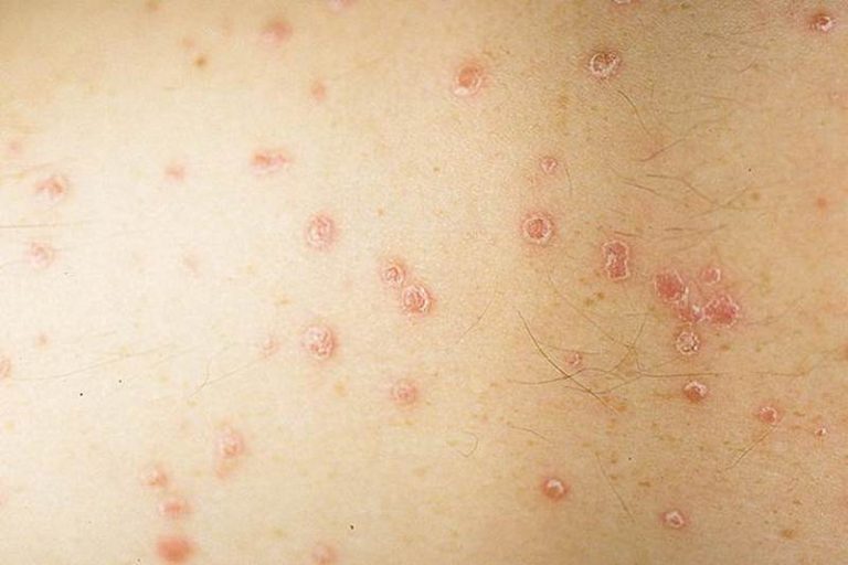 Guttate psoriasis images | Symptoms and pictures