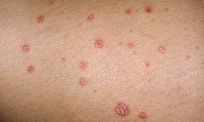 Guttate psoriasis pictures 2