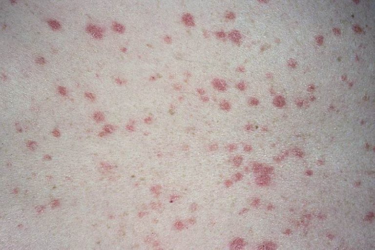 Guttate psoriasis symptoms pictures | Symptoms and pictures