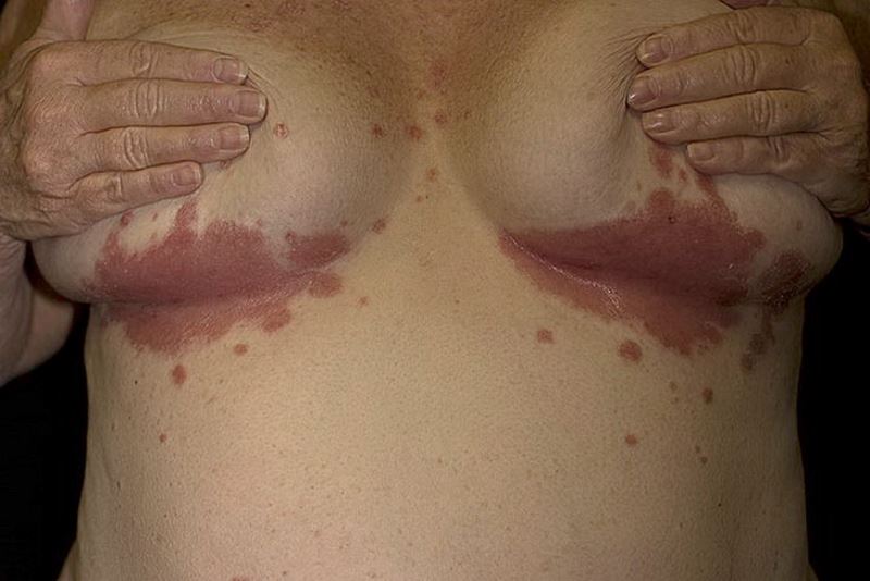 Inverse psoriasis pictures 2