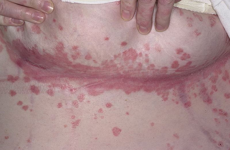 Inverse psoriasis pictures