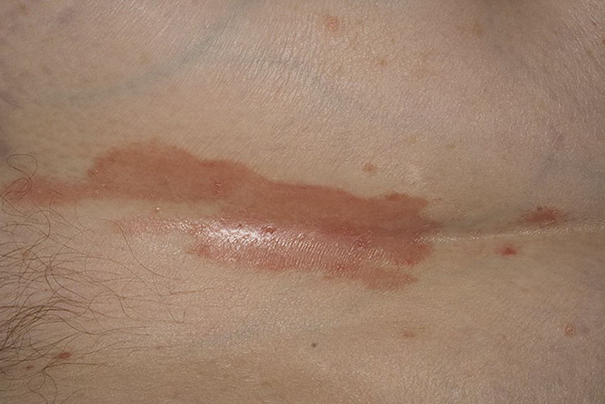 Inverse psoriasis symptoms pictures