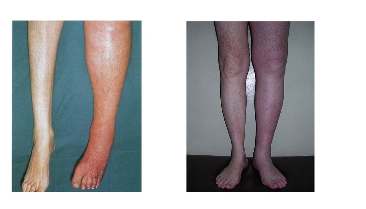 Leg thrombosis signs pictures