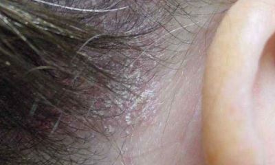 Mild psoriasis pictures 2