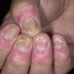 Nail psoriasis photos