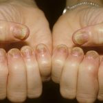 Nail psoriasis pictures