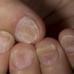 Nail psoriasis symptoms pictures