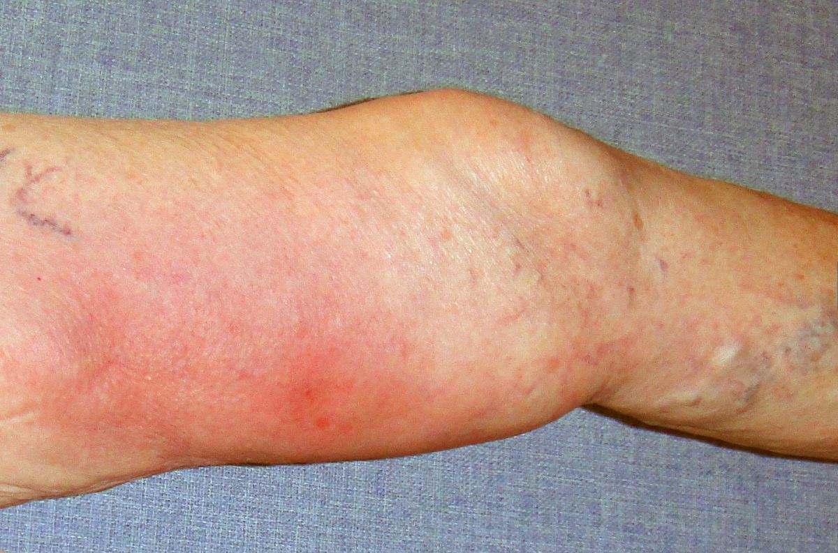 Phlebitis pics