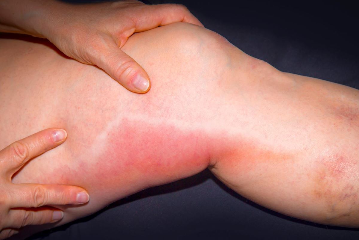 Phlebitis rash pictures